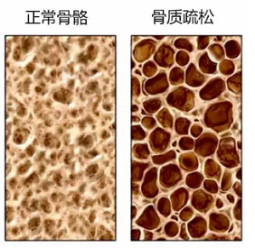 草莓视频入口检测仪生产厂家骨质疏松老年人疾病年轻人需要做草莓视频入口检测吗